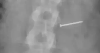 Женщина съела мороженое с гвоздями, стала бесплодной и получила $14 млн