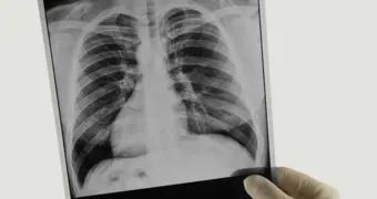 Общая статистика по туберкулезу сократилась в Актау