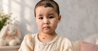 «Времени мало»: 3-летней Жасмине из Актау не хватает 4 млн тенге на новую операцию
