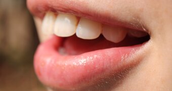 Стоматолог назвала напитки и продукты, которые могут повреждать эмаль зубов