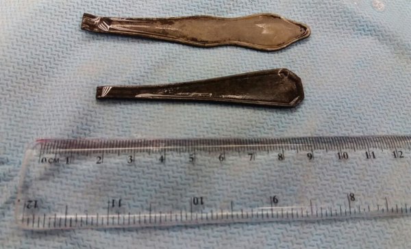 В Актау хирурги извлекли из желудка пациента две ручки от ложек