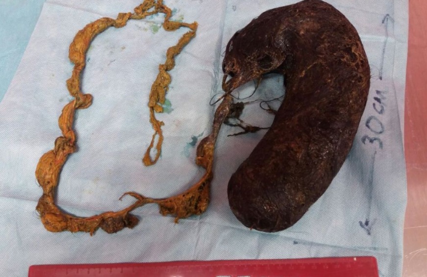 Косички и вредные привычки: В Мангистау из желудка школьницы извлекли 30-сантиметровый комок волос