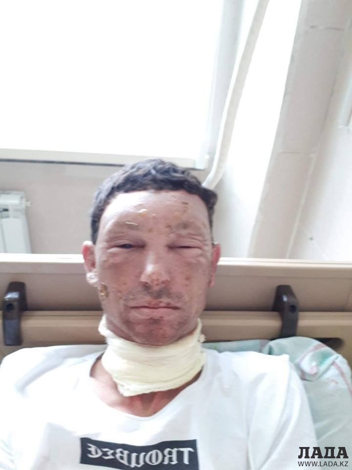 Пострадавший при пожаре в гаражном кооперативе в Актау мужчина просит о помощи
