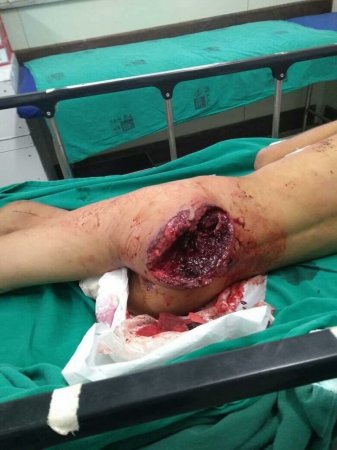 Взорвался телефон в кармане: Слухи о пострадавшем в Актау не подтвердились