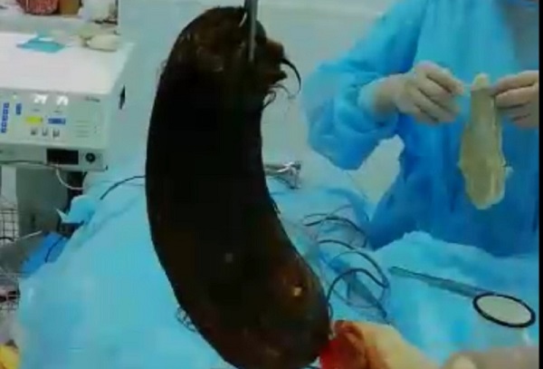 Врачи удалили из желудка подростка более трех килограммов волос в Актау