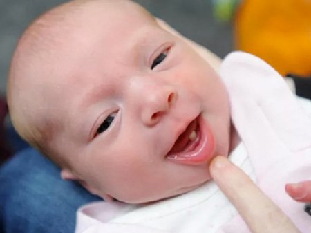 Ребенок родился с полноценным зубом и удивил врачей