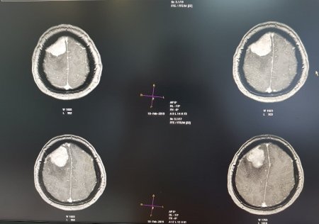 Опухоль мозга диаметром семь сантиметров удалили пенсионерке врачи Мангистау