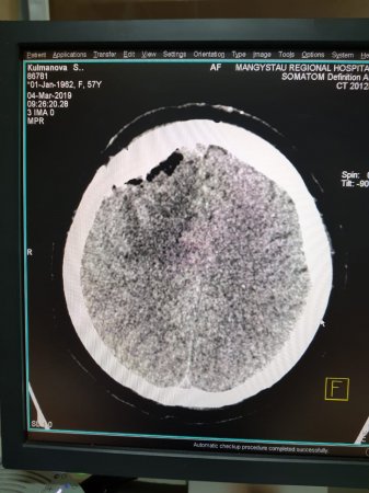 Опухоль мозга диаметром семь сантиметров удалили пенсионерке врачи Мангистау