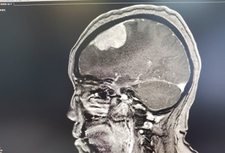 Опухоль мозга диаметром семь сантиметров удалили пенсионерке врачи Мангистау