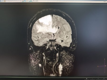 Опухоль мозга диаметром семь сантиметров удалили пенсионерке врачи Мангистау