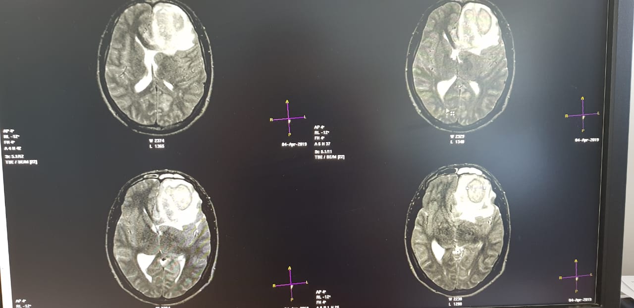 Врачи Актау провели операцию на головном мозге гражданину Афганистана