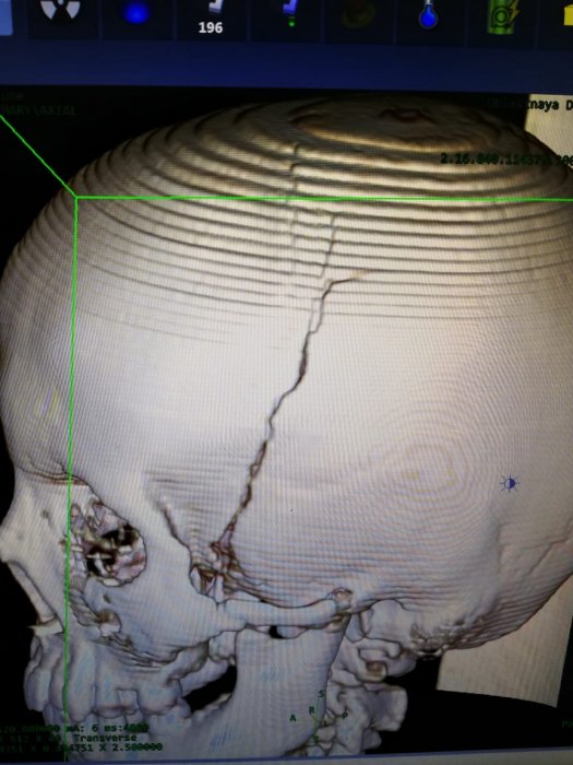 По факту падения футбольных ворот на мальчика в Жетыбае к ответственности привлекут директора школы