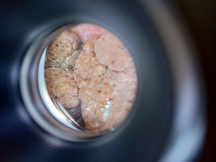 Более 50 жителей Актау проверили свои родинки на меланому