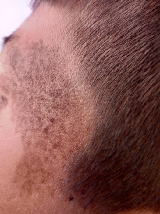 Более 50 жителей Актау проверили свои родинки на меланому