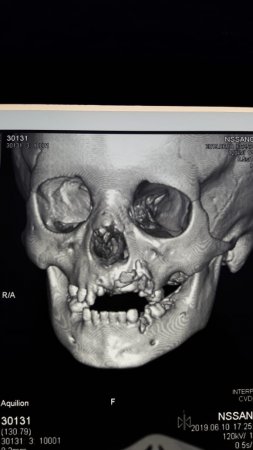 К операции после удара копытом в лицо готовят мальчика из Мангистау