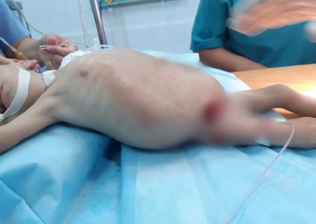 Огромную опухоль удалили у ребёнка в Мангистау