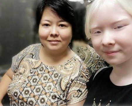Белоснежки: В актауской семье родились два ребенка-альбиноса