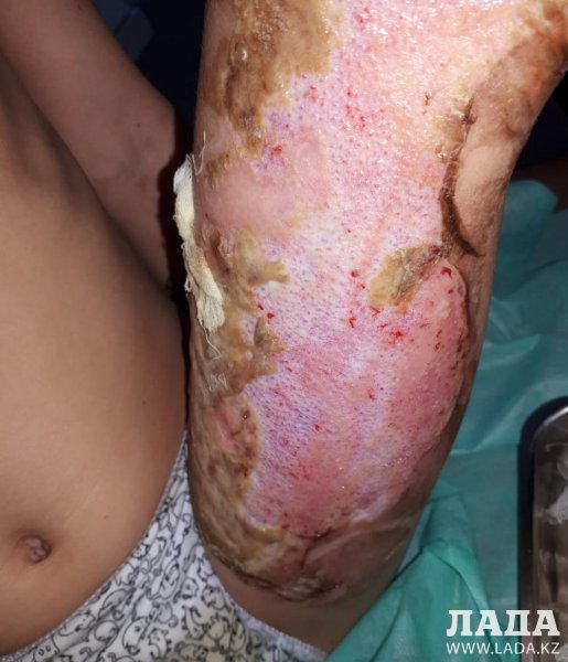 Родители ошпаренной в детском саду Актау девочки требуют наказать виновных