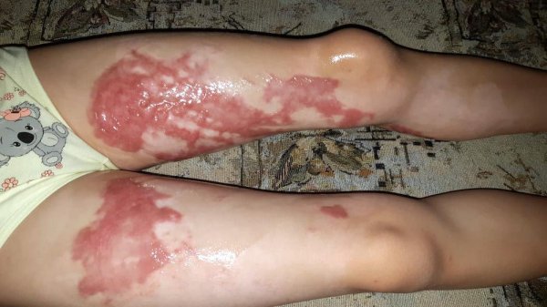 Родители ошпаренной в детском саду Актау девочки требуют наказать виновных