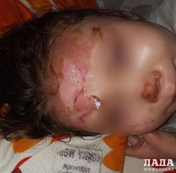 Родители ошпаренной в детском саду Актау девочки требуют наказать виновных