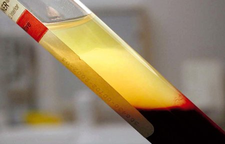 Плазму крови переболевших КВИ продают на черном рынке за 1,5 млн тенге
