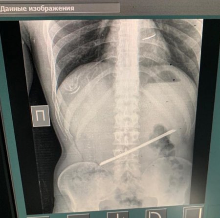 Алматинец 2,5 года прожил с 25-сантиметровой арматурой в желудке