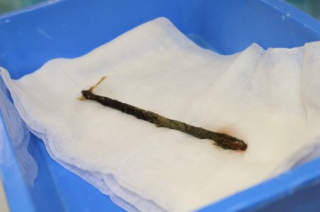 Алматинец 2,5 года прожил с 25-сантиметровой арматурой в желудке