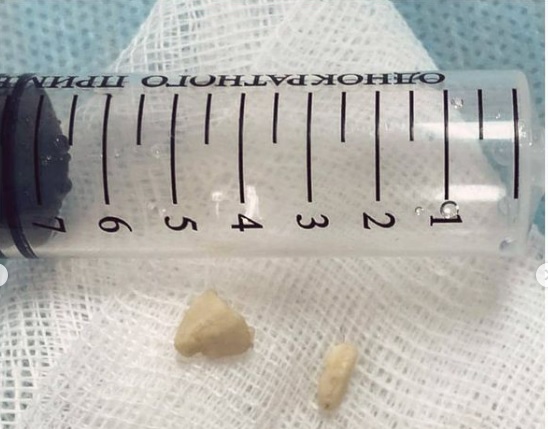 В Актау из бронхов полуторагодовалого ребёнка извлекли кешью