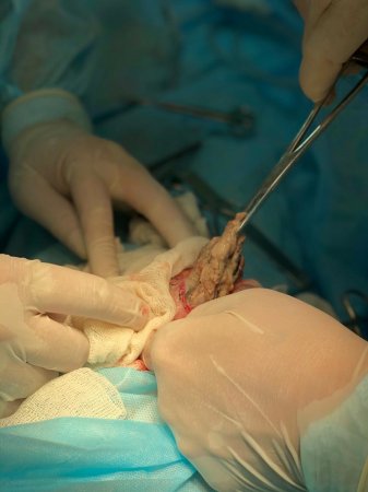 Комок волос извлекли из желудка ребёнка врачи в Мангистау