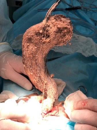 Комок волос извлекли из желудка ребёнка врачи в Мангистау