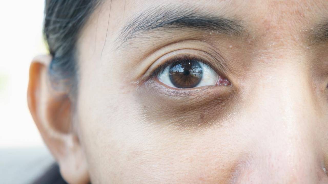 Под глазами желтые круги почему. Гиперпигментация кожи периорбитальной области. Круглый коричневый синяк.