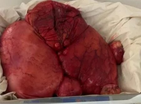 Алматинские хирурги вытащили из женщины гигантского червя весом 7,5 кг