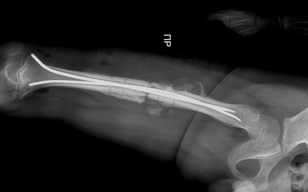 Гибкие фиксирующие стержни установили врачи юному жителю Актау