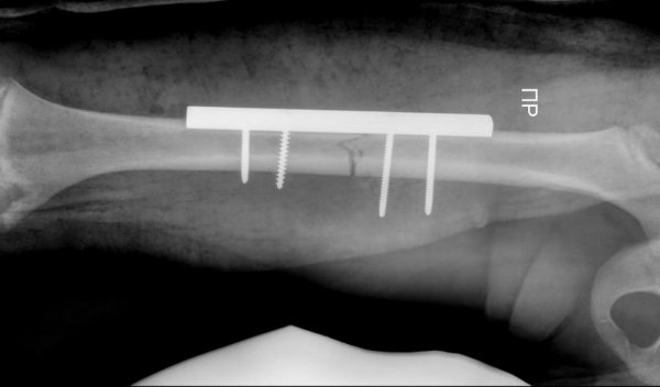 Гибкие фиксирующие стержни установили врачи юному жителю Актау