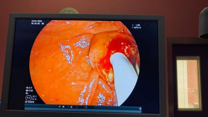 Мангистауские врачи провели одну из самых технически сложных операций