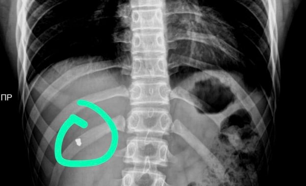 Пулю из груди подростка извлекли врачи в Актау