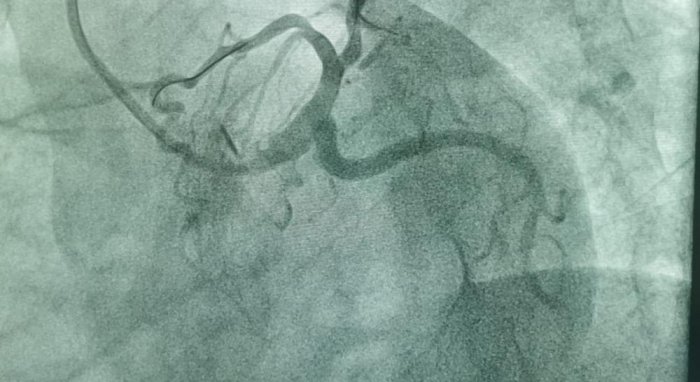 В Мангистау врачи спасли жизнь 70-летнему мужчине