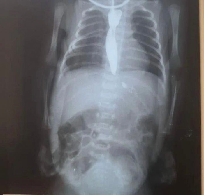 В Актау проведена операция на пищеводе новорождённого