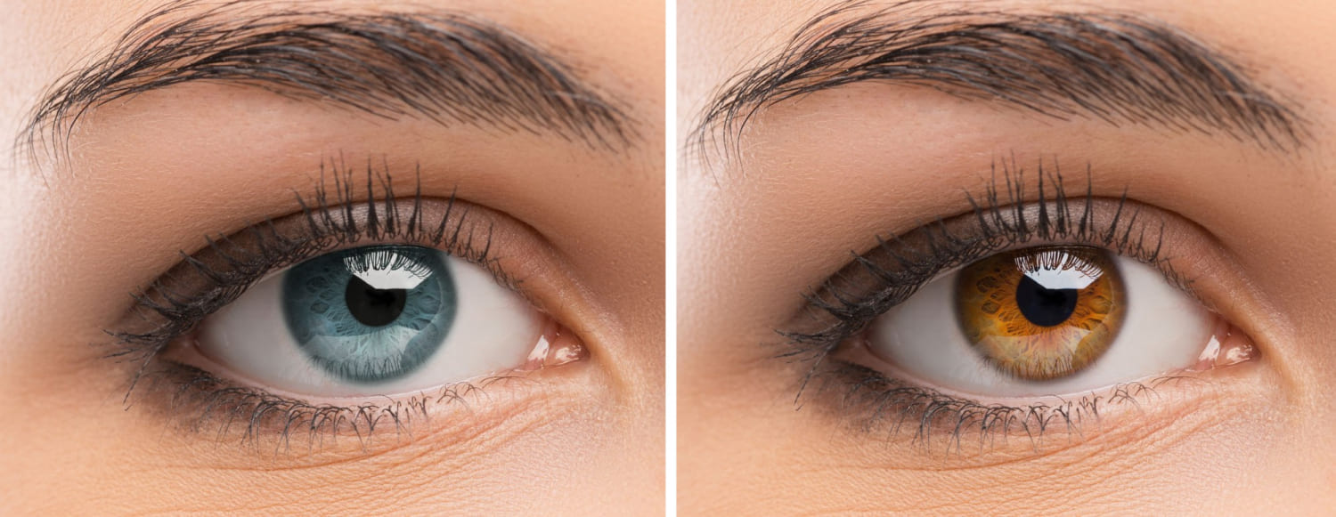 Лазерная коррекция цвета глаз возможно ли?
