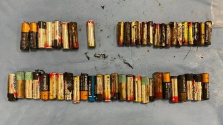 Врачи извлекли 55 батареек из желудка женщины 