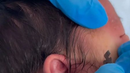 "Хиджама запрещена". Видео с надрезами на лице ребенка прокомментировал Минздрав