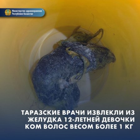 Больше килограмма волос извлекли из желудка девочки в Таразе