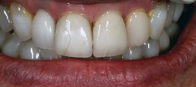 Что делать, если на зубе появилась трещина?