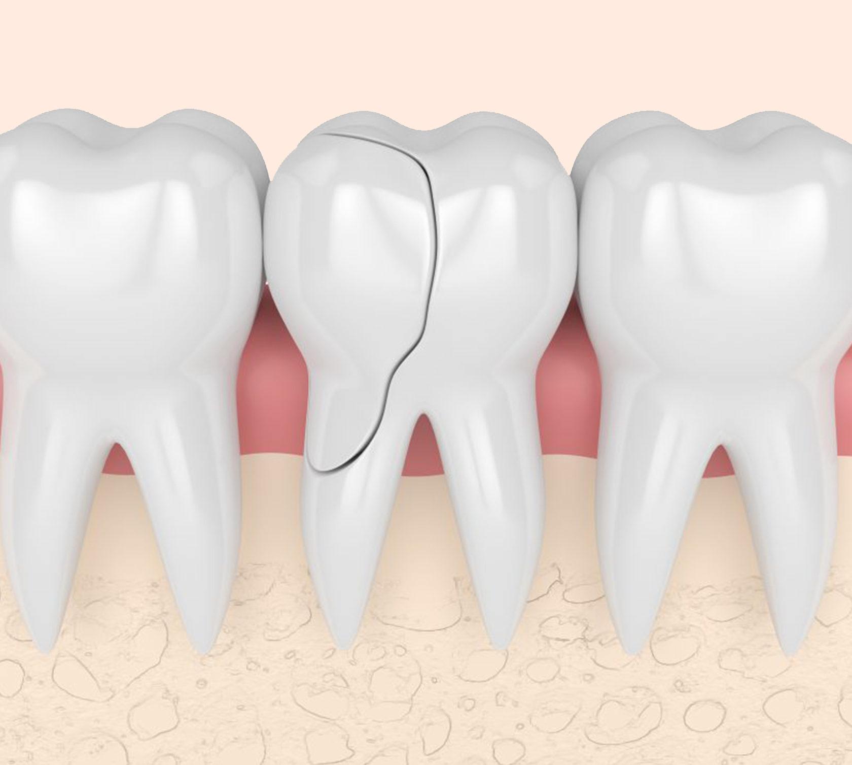 Что делать, если на зубе появилась трещина?