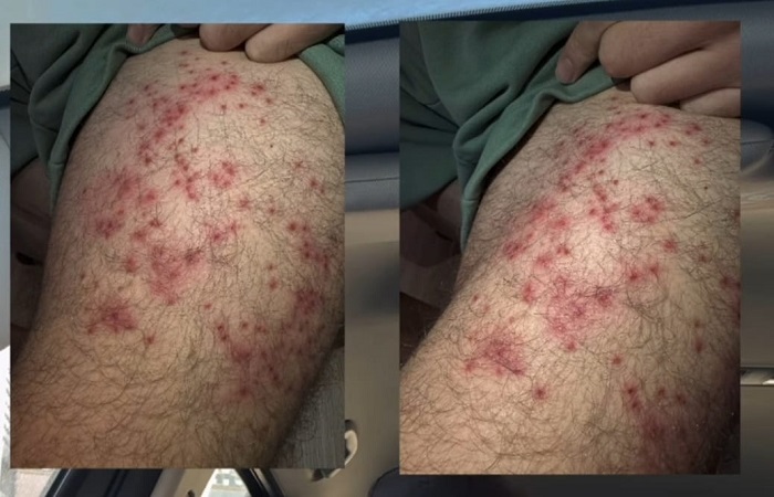 Жительница Актау заявила о заболевании мужа фолликулитом после посещения массажного салона