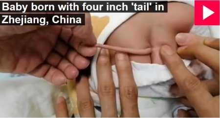 Уникальный ребенок с 10-сантиметровым хвостом родился в Китае